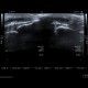 Calcification in patellar ligament, infrapatellar bursa: US - Ultrasound